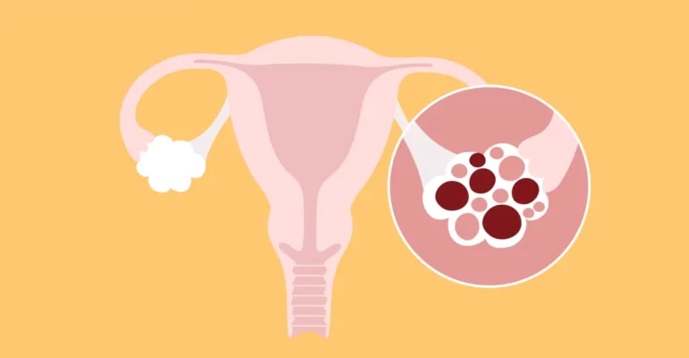 PCOS- polycystic ovary syndrome